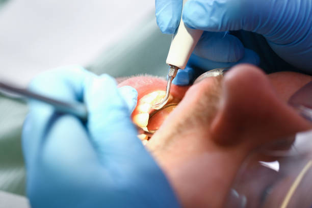 Best Emergency Tooth Extraction in Farmersville, TX