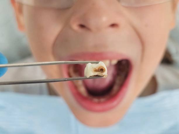 Best Emergency Tooth Extraction in Farmersville, TX